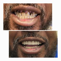 Crystal Bright Smile - 6 All Ceramic Crowns. Non-invasive Confident Smile make over in one week!