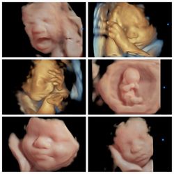 Hey Baby Mobile 4D Ultrasound