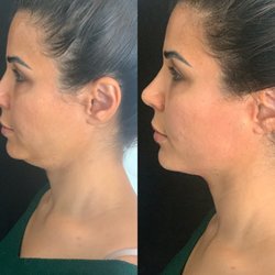 Rouge Medical Spa - Double chin fat dissolving
