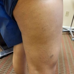 Virginia Vein Care