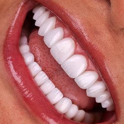 Just Smile Miami - Just Smile Miami - Porcelain Veneers