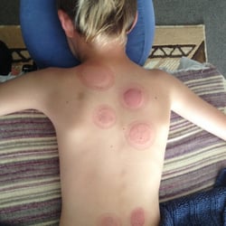 At the Waters' Edge Massage - Get those sore muscles fire cupped! (For adults too!)