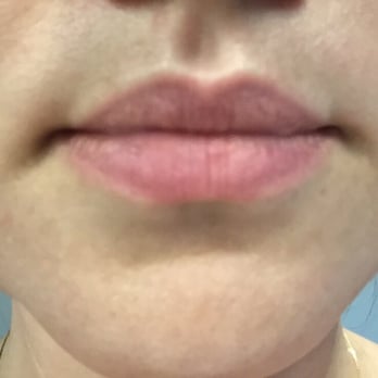 Savva Skin Therapy - 3 hrs after sugaring - no irritation, no redness, no swelling. - Skin Care Near Me - Burbank, California Savva Skin Therapy - 3 hrs after sugaring - no irritation, no redness, no swelling. - Skin Care Near Me - Burbank, California