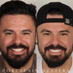 Orange and Magnolia Dental Studio - 10 porcelain veneers by Dr Joyce kahng in Newport Beach