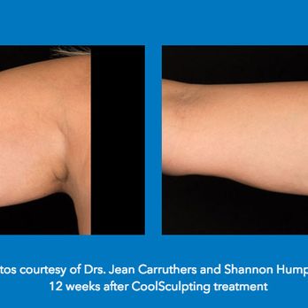 Zap Laser Center - Freeze away unwanted fat with CoolSculpting. - Laser Hair Removal Near Me - Aurora, Colorado Zap Laser Center - Freeze away unwanted fat with CoolSculpting. - Laser Hair Removal Near Me - Aurora, Colorado
