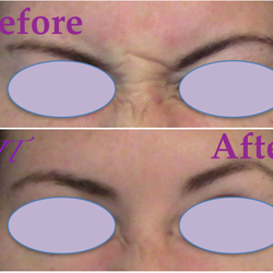 Jennifer Trent, MD FAAD - Before and After Botox Injections in Glabella.