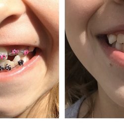 John A Hedrick, DDS MS - Before and after of my daughter's teeth. Great work!