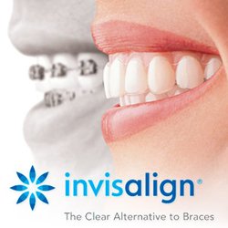 Natalie Provenzano, DDS - The invisible way to straighten your teeth without braces.