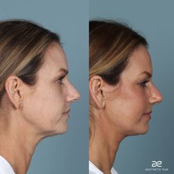 Luis Macias, MD, FACS - Deep plane face and neck lift, brow lift, with fat grafting to mid face. One year post-op!