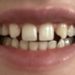 Bahri Dental Group - Teeth spaced out after refusing retainer. Lateral incisors extracted