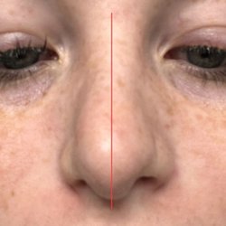 James S Toung MD - Texas Ear, Nose & Throat Specialists - Before surgery, you can see how swollen my turbinates were which also caused restriction of breathing on top of the deviated septum