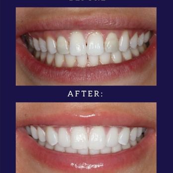 Cynthia Stephenson, DDS - High quality feldspathic porcelain looks amazing and is the most conservative lasting approach. - General Dentistry Near Me - Walnut Creek, California Cynthia Stephenson, DDS - High quality feldspathic porcelain looks amazing and is the most conservative lasting approach. - General Dentistry Near Me - Walnut Creek, California