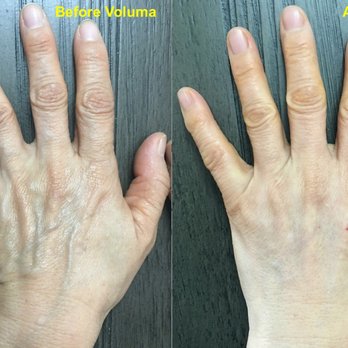 Song Dermatology - One syringe of Voluma to the left hand - Dermatologists Near Me - Carrollton, Texas Song Dermatology - One syringe of Voluma to the left hand - Dermatologists Near Me - Carrollton, Texas