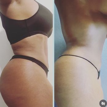 Holistic Wellness Curves - Body Contouring Near Me - Sacramento , California