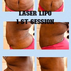 Shape it Up Contouring - Laser Lipo 1st session