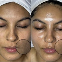 LX Aesthetics - Bye bye dry skin,fine lines and peach fuzz
