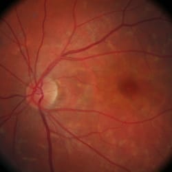 El Rancho Eye Care - Digital retinal photos taken with our Hi-Res Retinal Camera aid in diagnosis and treatment of eye diseases.