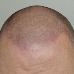 Only hours after the FIRST treatment!!! Only hours after the FIRST treatment!!!