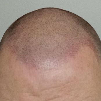Trillium Ink Studios - Only hours after the FIRST treatment!!! - Hair Loss Centers Near Me - Tigard, Oregon Trillium Ink Studios - Only hours after the FIRST treatment!!! - Hair Loss Centers Near Me - Tigard, Oregon
