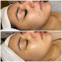 Skin Deep By Whitney at Nurtura Medspa - Acne program before & after