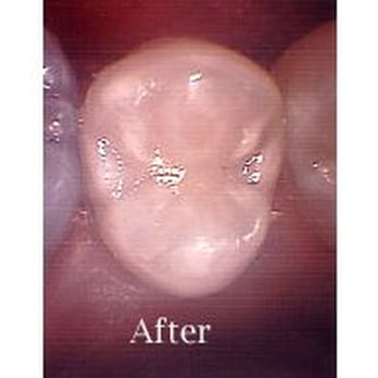 Irving J Leonard, DDS - Sealant to Prevent Decay - Oral Surgeons Near Me - Chicago, Illinois