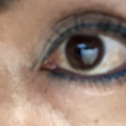 Rodrigo Belalcazar, MD - Advanced Eye Center
