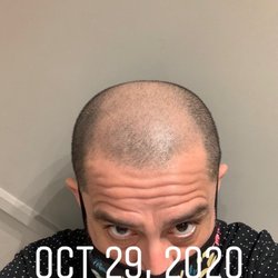 Scalp New England - This is before micro-pigmentation by Brian at Scalp New England