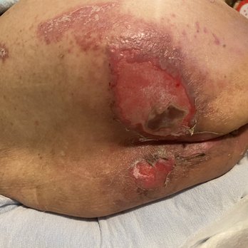 Del Rosa Villa - In only 8 days of being at this facility this is what my moms bottom looks like!!! This is ABUSE!! - Skilled Nursing Near Me - San Bernardino, California Del Rosa Villa - In only 8 days of being at this facility this is what my moms bottom looks like!!! This is ABUSE!! - Skilled Nursing Near Me - San Bernardino, California