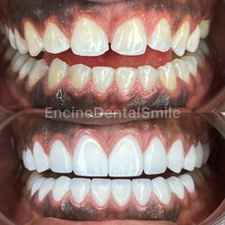 Encino Dental Smile - Combination of gum contouring and full mouth porcelain veneers done to perfection!
