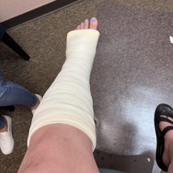 Katherine L. Kalthoff, DPM - Day 1 of 4 weeks in a cast