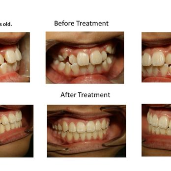 Ipro Dental - Orthodontic Treatment - General Dentistry Near Me - Cupertino, California Ipro Dental - Orthodontic Treatment - General Dentistry Near Me - Cupertino, California