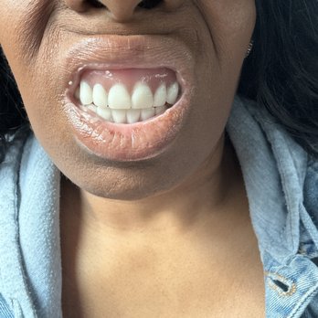 Colonial Heights Dental Care - Straight plastic not natural just a mess - Cosmetic Dentists Near Me - Colonial Heights, Virginia Colonial Heights Dental Care - Straight plastic not natural just a mess - Cosmetic Dentists Near Me - Colonial Heights, Virginia
