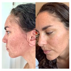 Ethereal Skincare - Results of 2 Nano Skin Refining Facials along with daily use of proper at home regimen