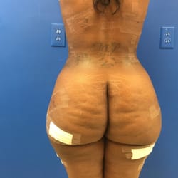 Celebrity Body Sculpting - Liposuction/ Brazilian Butt lift, 10 day post-op picture 7/5/16