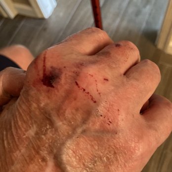 Akumin - Torn skin on hand - Radiologists Near Me - Coconut Creek, Florida