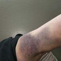 CSL Plasma - This is how my arm looked, this is when it was better