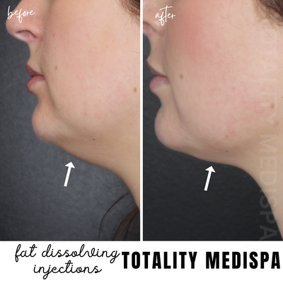 Fat Dissolving Injections - Some fat deposits can be tough to get rid of. They commonly occur on parts of the body that are difficult to treat with exercise, leaving you with a double chin, flabby thighs or hips. But now there’s a solution for these problem zones: the lipolysis injection. Lipolysis is a controlled method for dissolving small, stubborn fat deposits. Fat Dissolving Injections - Some fat deposits can be tough to get rid of. They commonly occur on parts of the body that are difficult to treat with exercise, leaving you with a double chin, flabby thighs or hips. But now there’s a solution for these problem zones: the lipolysis injection. Lipolysis is a controlled method for dissolving small, stubborn fat deposits.