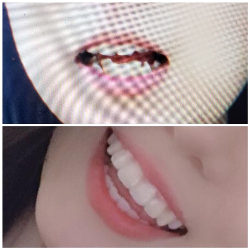 Before and after. Thanks Dr. Uchida!! Before and after. Thanks Dr. Uchida!!