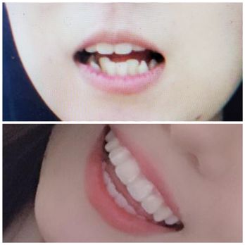 Smiles Forever, LLC - Before and after. Thanks Dr. Uchida!! - Oral Surgeons Near Me - Honolulu, Hawaii