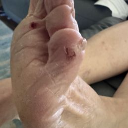 Over zealous "sanding "of my feet. Still hurt! Over zealous "sanding "of my feet. Still hurt!