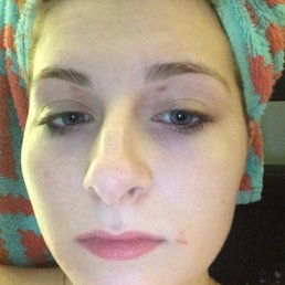 My face three days after getting my brows and lip waxed. Please note missing skin under eyebrows and next to mouth.