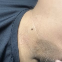 Skin tag removal .