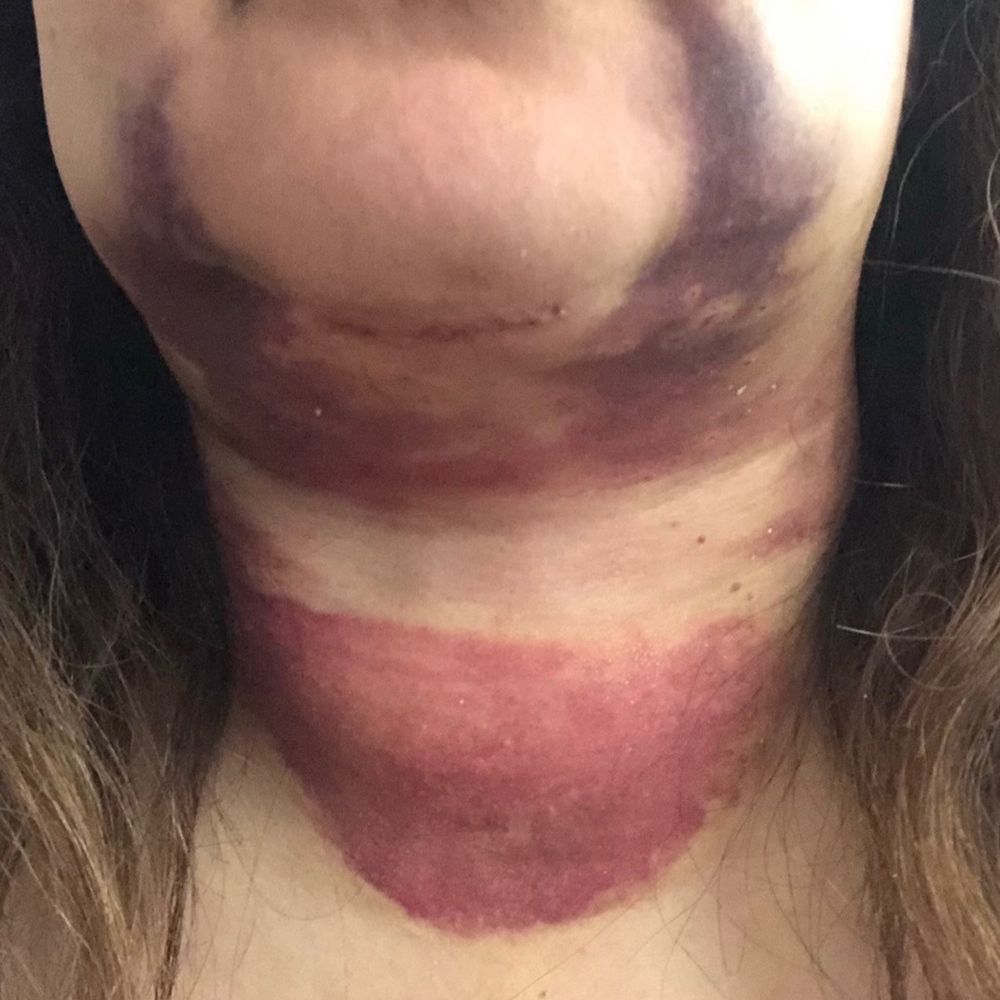 Batal Plastic Surgery - True recovery story. Don't  believe the fake Torres's photos. This was well over ten days after the surgery... - Plastic Surgeons Near Me - Santa Monica, California
