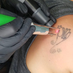 Unbranded Austin - Laser Tattoo Removal