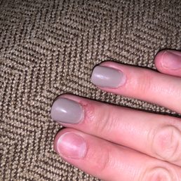 Infected nail bed from powder dip ( her fingers also chipped after 10 days from the powder dip. Infected nail bed from powder dip ( her fingers also chipped after 10 days from the powder dip.