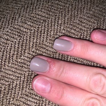 Pretty Nails And Spa - Infected nail bed from powder dip ( her fingers also chipped after 10 days from the powder dip. - Nail Salons Near Me - Fairlawn, Ohio Pretty Nails And Spa - Infected nail bed from powder dip ( her fingers also chipped after 10 days from the powder dip. - Nail Salons Near Me - Fairlawn, Ohio