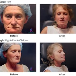 Ruwanthi Campano, MD - CO2 Laser Resurfacing Before and After by Dr. Campano. Individual results may vary.