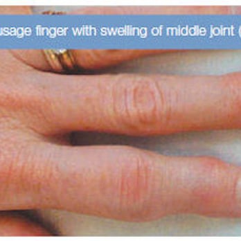 William Van Wyk, MD - Psoriatic Arthritis of the Hand - Dallas/Ft Worth Hand Surgeon - Surgeons Near Me - Fort Worth, Texas William Van Wyk, MD - Psoriatic Arthritis of the Hand - Dallas/Ft Worth Hand Surgeon - Surgeons Near Me - Fort Worth, Texas