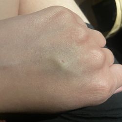 UCR Health - Riverside South - Bruise