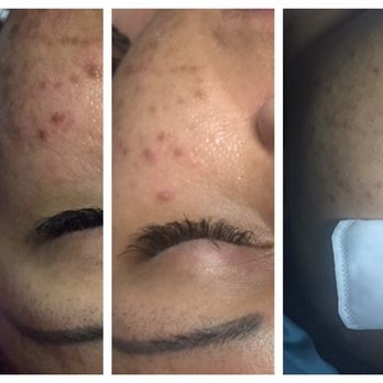 Brooke Webb Esthetics - Acne Treatment results with 3 facials and home care - Eyelash Service Near Me - Fayetteville, North Carolina Brooke Webb Esthetics - Acne Treatment results with 3 facials and home care - Eyelash Service Near Me - Fayetteville, North Carolina